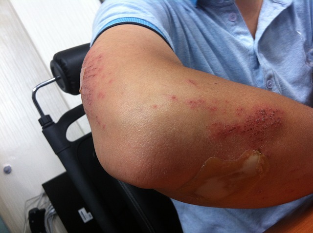 Gomito del tennista – Informazioni e trattamento per lesioni doloros